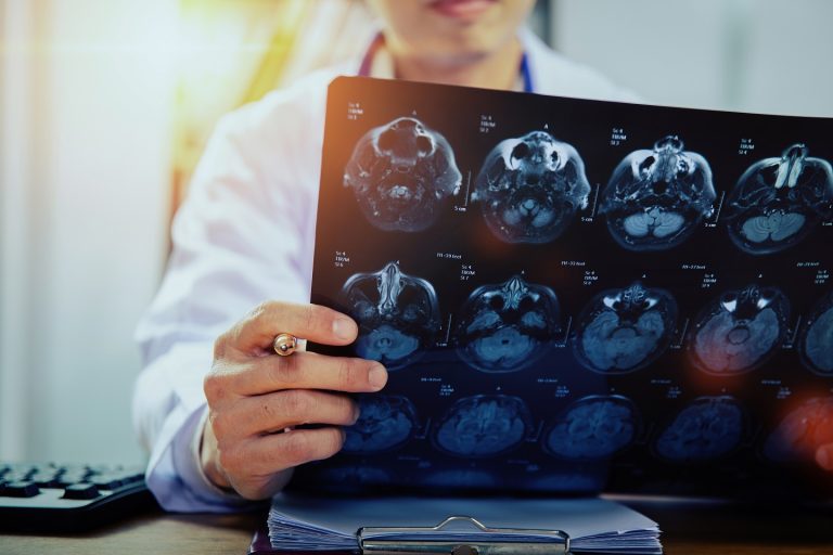 AVC em jovens: traumas leves no pescoço podem causar acidente vascular cerebral